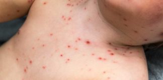 Во Гевгелија прогласена епидемија на морбили, регистрирани 9 случаи со мали сипаници